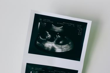 ultrasound picture of unborn baby on white background